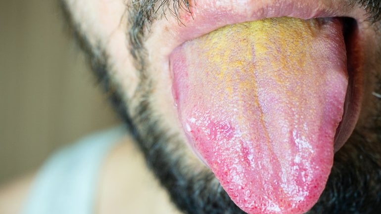 Gelber Belag auf der Zunge