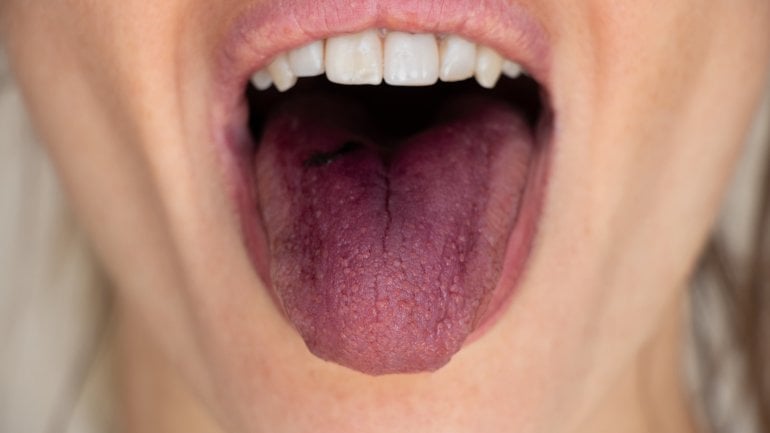 Blau verfärbte Zunge