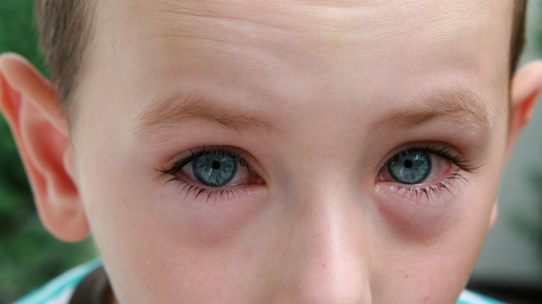 Gerötete Augen sind erstes Symptom