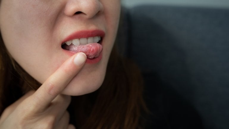Eine Frau streckt ihre Zunge raus, auf der ein kleines Geschwür zu sehen ist