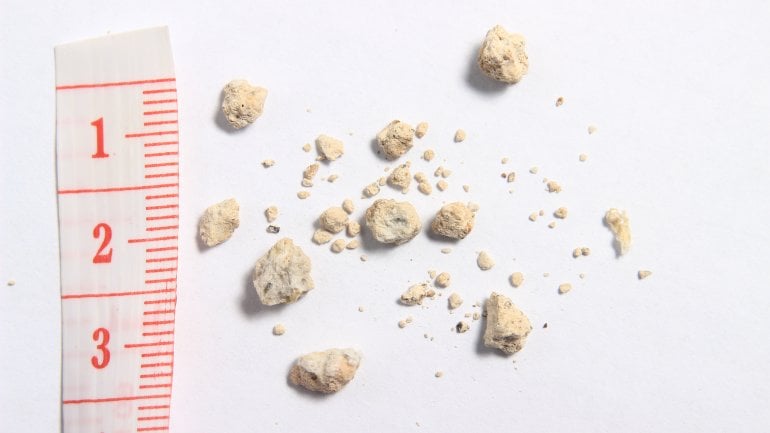 Das Bild zeigt Blasensteine