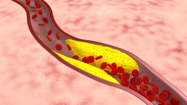 Eine schematische Darstellung einer Blutbahn mit Arteriosklerose.
