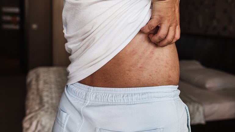 Blutverdünner: Hautausschlag als Nebenwirkung