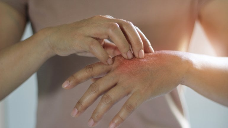 Späte Borreliose-Symptome: Verfärbung der Haut