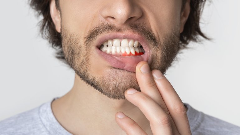 Zahnfleischentzündungen