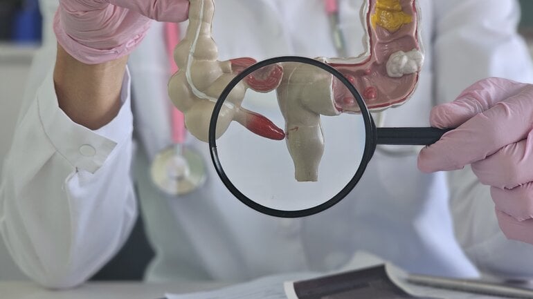 Darmkrebs-Mythos: Vorsorge ist nur bei Beschwerden nötig