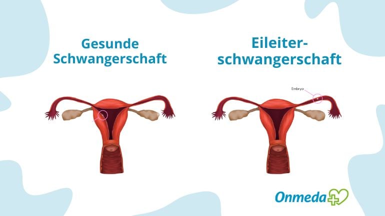 Eileiterschwangerschaft: Symptome & Behandlung