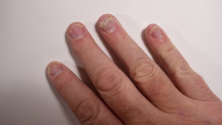 Tüpfelnägel: Anzeichen für Nagelpsoriasis