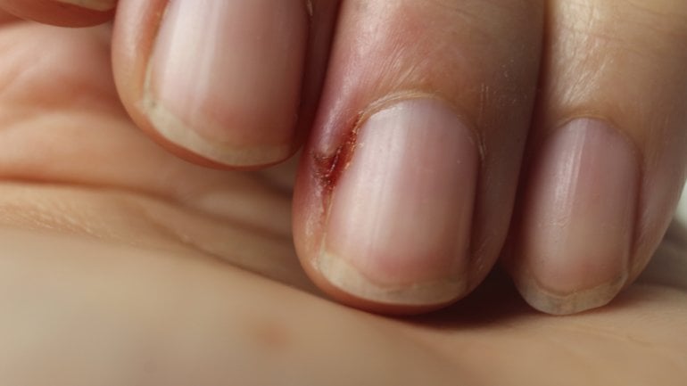 Bild von eingewachsenem Fingernagel