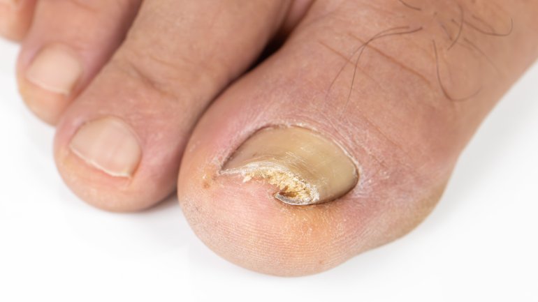 Krankheiten der Fußnägel: Bild von Rollnagel