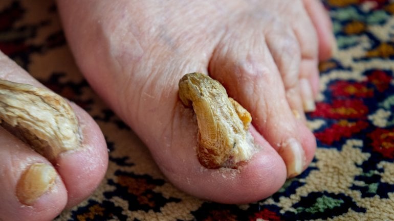 Bilder von Krankheiten der Fußnägel: Krallennagel