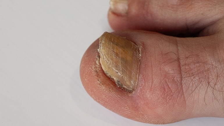 Krankheiten der Fußnägel: Bild zeigt Holznagel