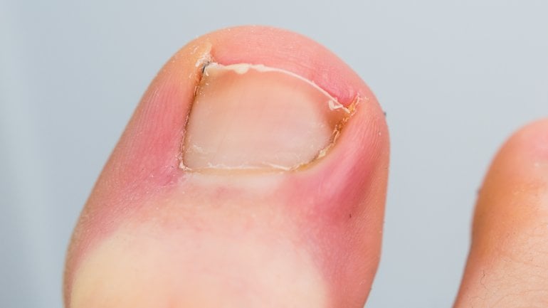 Krankheiten an den Fußnägeln: Bild einer Nagelbettentzündung