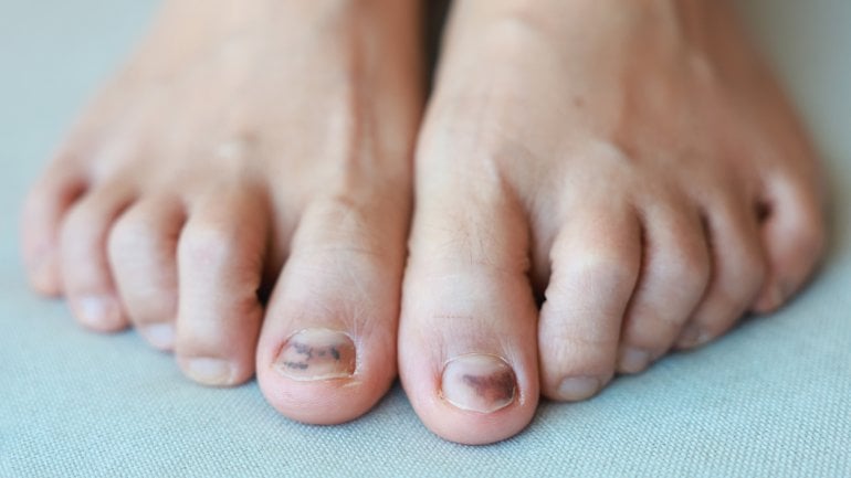 Zehennagel wird blau: Bild zeigt Bluterguss unter dem Fußnagel