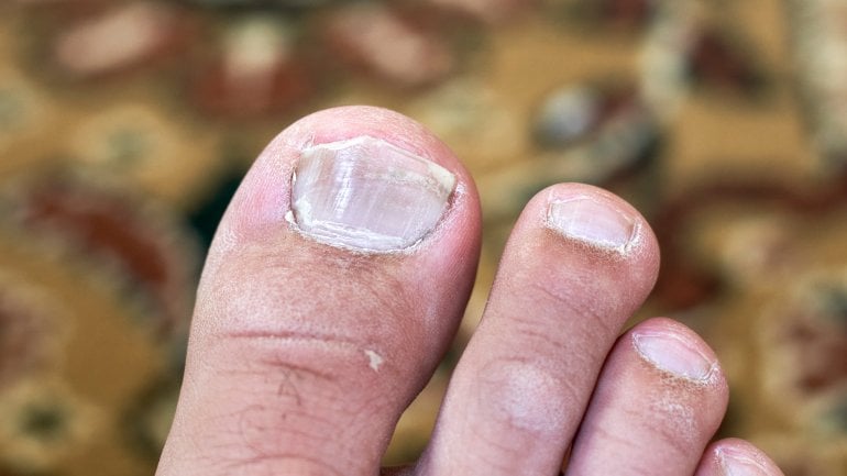 Fußnagel wird weiß: Welche Krankheit steckt dahinter?