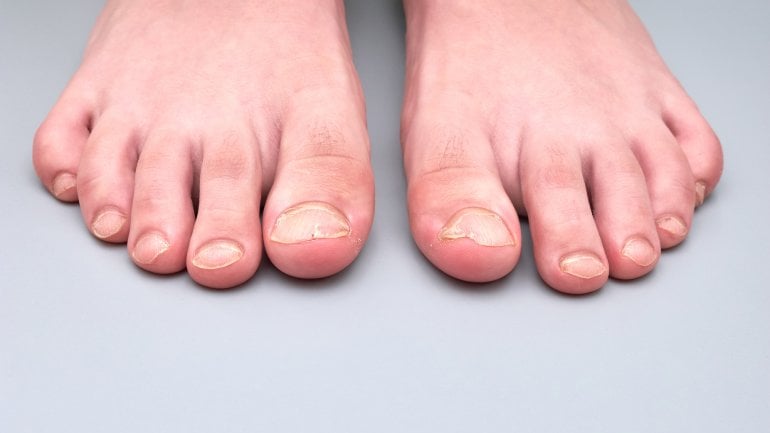 Brüchige Fußnägel: Mangel als Ursache?