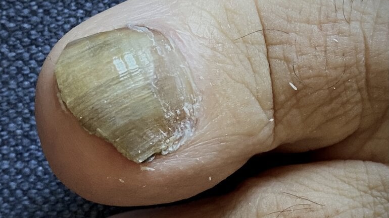 Verdickte Zehennägel: Kein Pilz als Ursache?