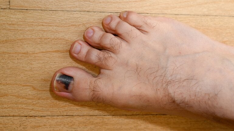 Schwarzer Zehennagel: Ist es Hautkrebs?