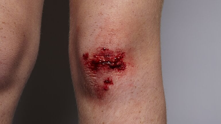 Schürfwunde gehört zu häufigen Wundarten