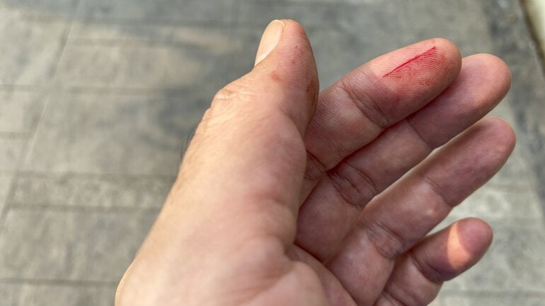 Wundarten: Schnittwunde