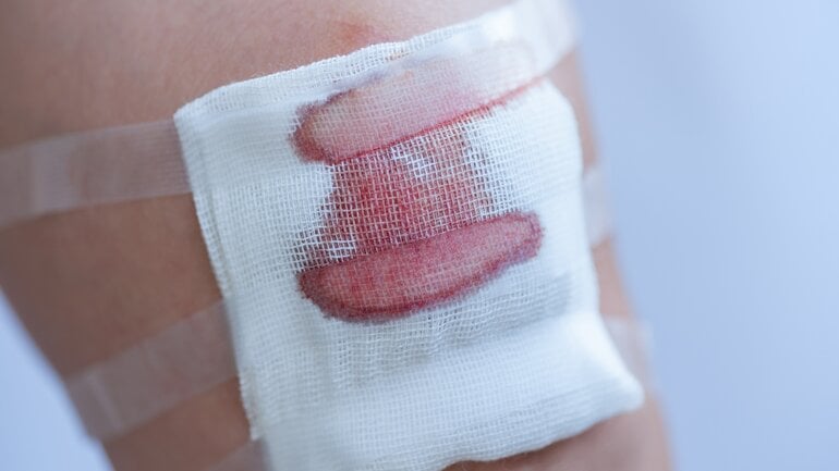 Nässende Wunde: Verbundene Wunde am Bein 