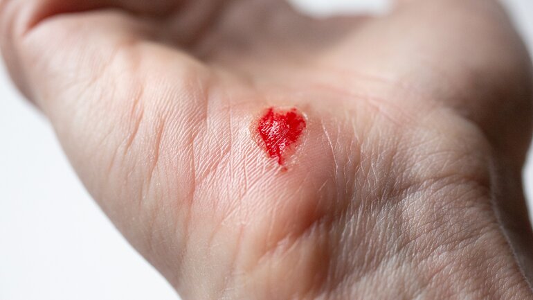 Bild einer akuten offenen Wunde