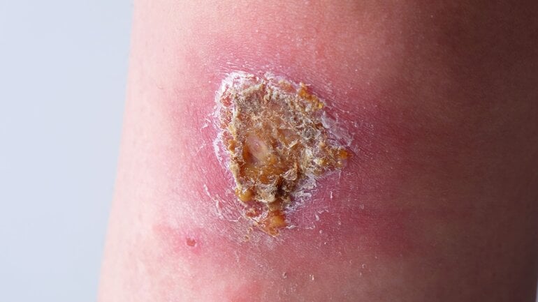 Wundarten mit Wundinfektion: Entzündete Schürfwunde 