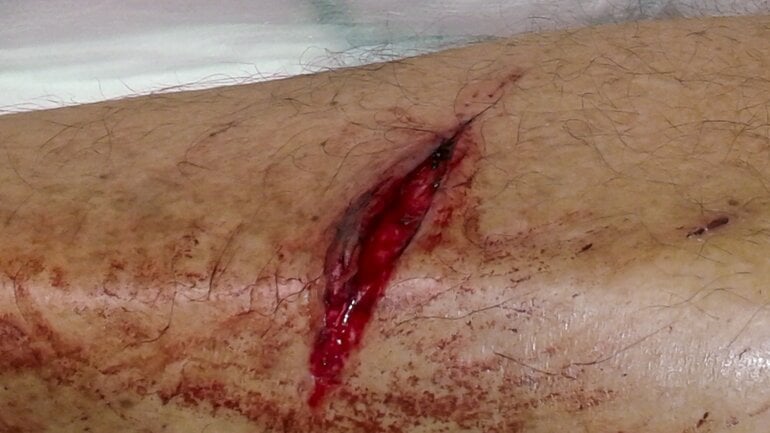 Wundarten: Klaffende Wunde