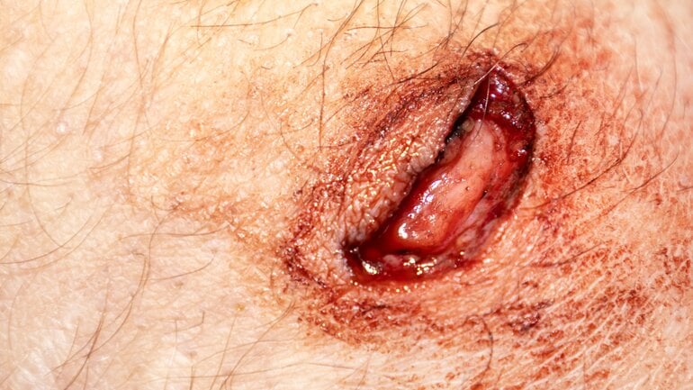 Wundarten: Bild von Ulcus cruris