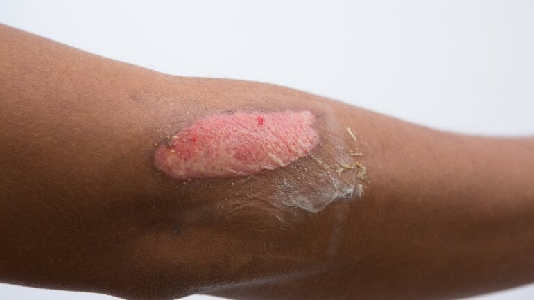 Bild von Brandwunde 2. Grades 