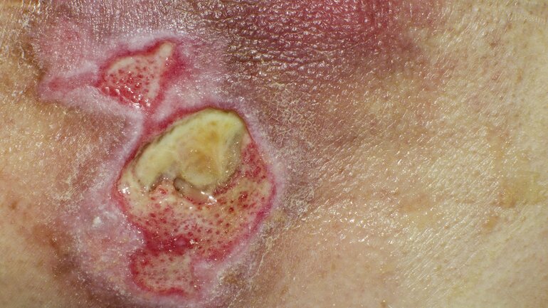 Infizierte Wunde: Bild einer entzündeten Wunde 