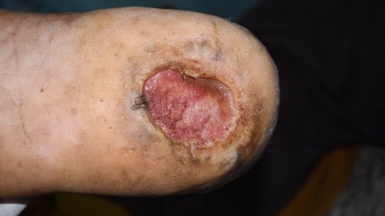 Dekubitus (Druckgeschwür) gehört zu Wundarten