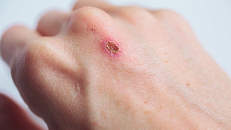 Überzuckerung: Verzögerte Wundheilung als Warnsignal