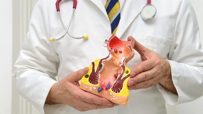 Vergrößerte Hämorrhoiden: Die häufigste Analerkrankung