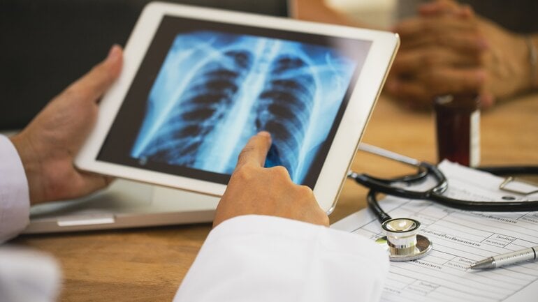 Mögliche Folge von Asbestbelastung: Lungenkrebs