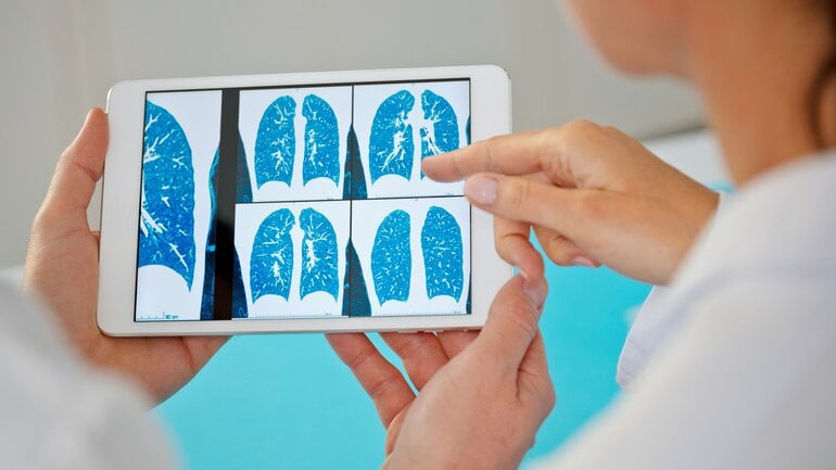 Pleura-Plaques: Hinweis auf frühere Asbestbelastung