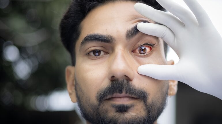 Bilder einer Augengrippe: Hochansteckende Infektion