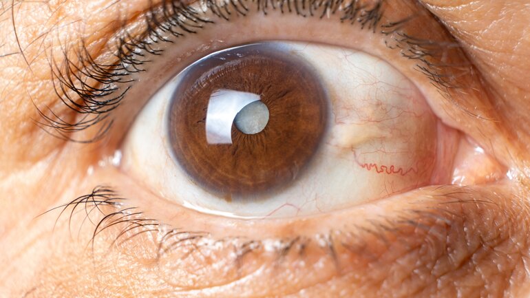 Grauer Star: Bild einer getrübten Linse