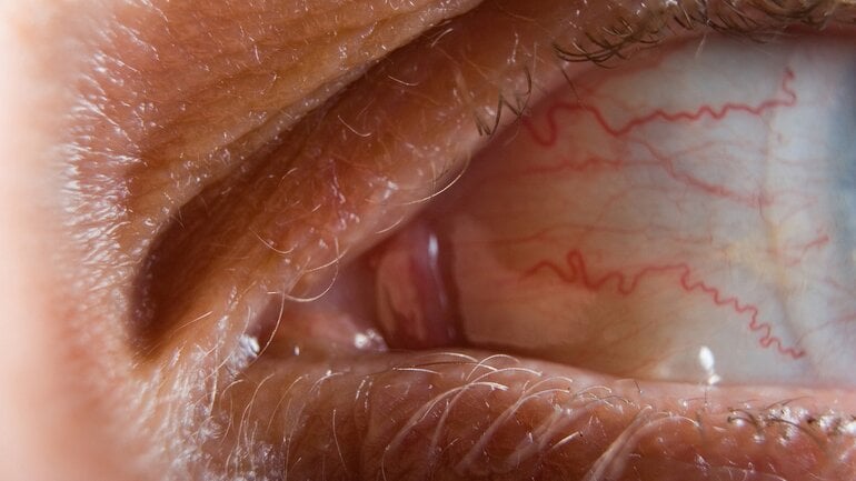 Meist harmlos: Geplatztes Äderchen im Auge