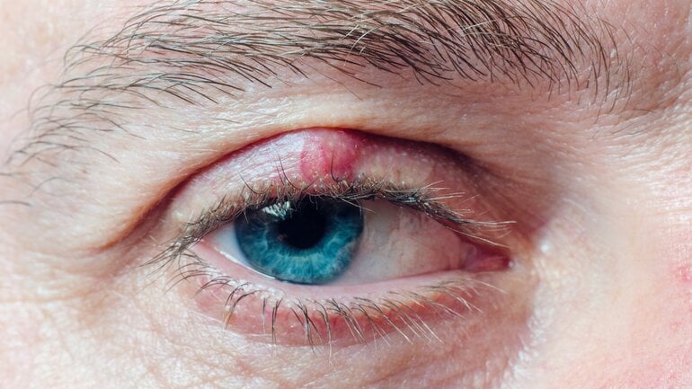 Augenkrankheit: Bild eines Hagelkorns