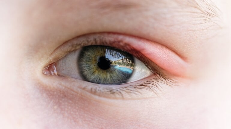 Schmerzhafte Lidrandentzündung: Häufige Augenerkrankung