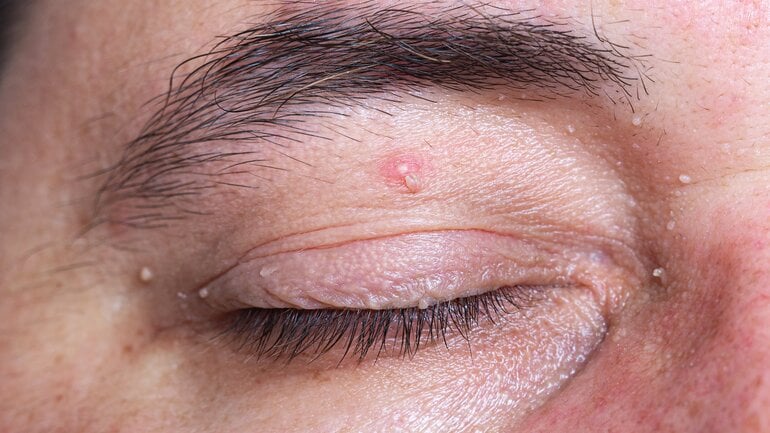 Gutartige Hautwucherungen: Papillome am Auge