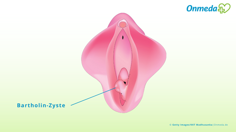 Bartholin-Zyste: Aussehen und Lage