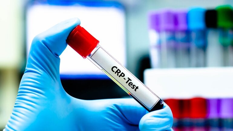 Bauchspeicheldrüse entzündet? CRP ist wichtiger Blutwert