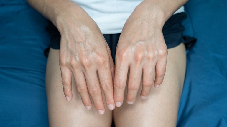 Sichtbare blaue Adern durch genetische Veranlagung 