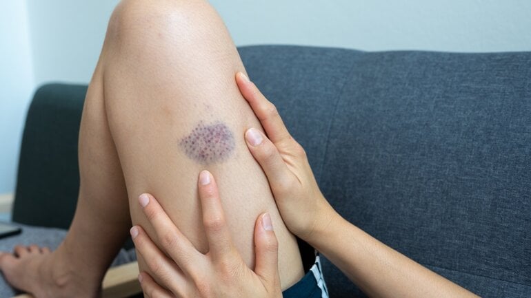 Blaue Flecken ohne Grund: Oft durch unbemerkte Stöße