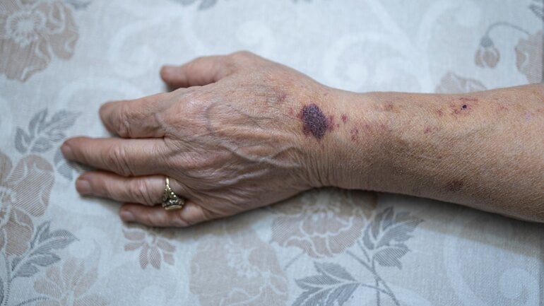Blaue Flecken ohne Grund? Im Alter keine Seltenheit