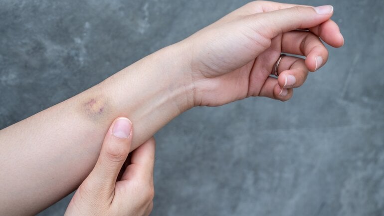 Dünne und empfindliche Haut: Oft genetisch bedingt