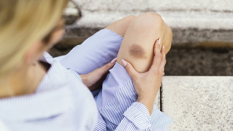 Vitaminmangel kann zu blauen Flecken führen