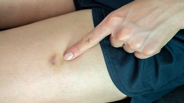 Venen- und Bindegewebsschwäche als Ursache